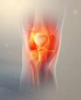 Dolore anteriore di ginocchio:la sindrome femoro-rotulea
